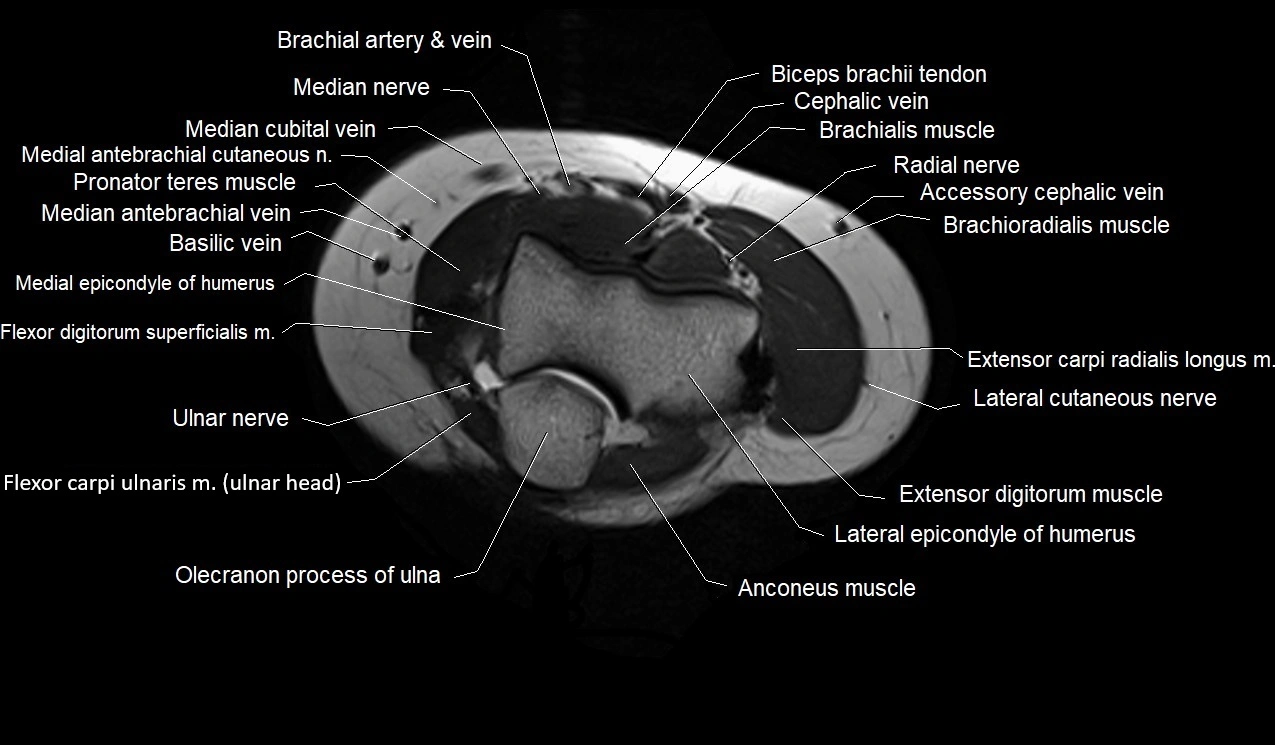 MRI 3T forearm axial cross sectional anatomy image 5.webp